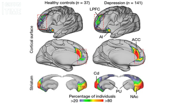 New Study Reveals Enlarged Brain Network in People with Depression